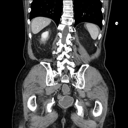 Closed loop obstruction due to adhesive band, resulting in small bowel ischemia and resection (Radiopaedia 83835-99023 E 99).jpg