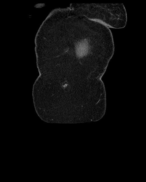Closed loop small bowel obstruction - adhesions (Radiopaedia 59269-66611 B 10).jpg