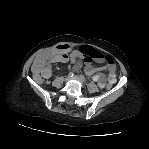 File:Closed loop small bowel obstruction due to adhesive band, with intramural hemorrhage and ischemia (Radiopaedia 83831-99017 Axial non-contrast 102).jpg