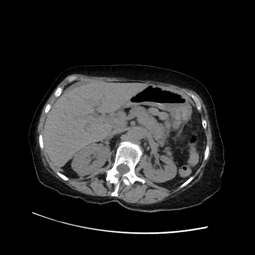 Closed loop small bowel obstruction due to adhesive band, with intramural hemorrhage and ischemia (Radiopaedia 83831-99017 Axial non-contrast 55).jpg