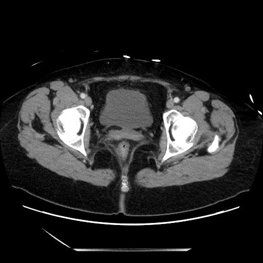 File:Closed loop small bowel obstruction due to adhesive bands - early and late images (Radiopaedia 83830-99014 A 145).jpg