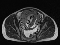 Closed loop small bowel obstruction in pregnancy (MRI) (Radiopaedia 87637-104031 D 27).jpg