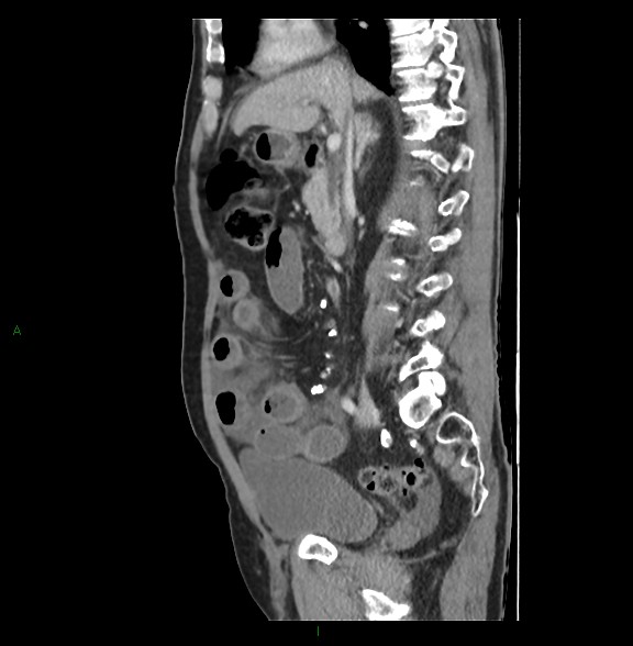 File:Closed loop small bowel obstruction with ischemia (Radiopaedia 84180-99456 C 40).jpg