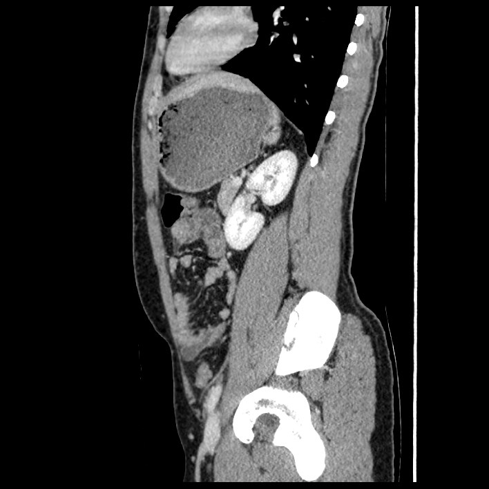 Co-existing acute appendicitis and epiploic appendagitis (Radiopaedia 61789-69911 B 67).jpg