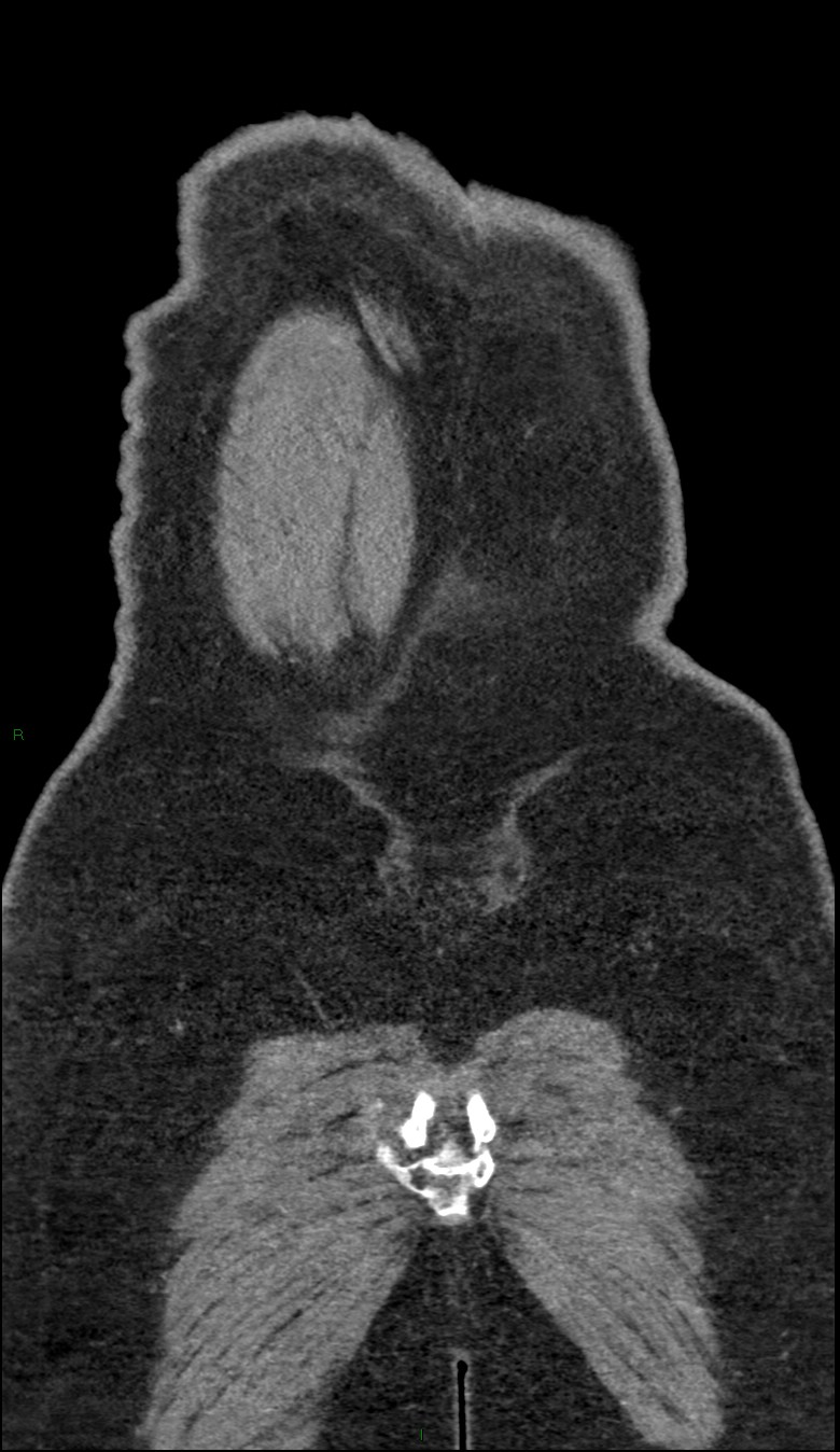 Coarctation of the aorta (Radiopaedia 74632-88521 B 258).jpg