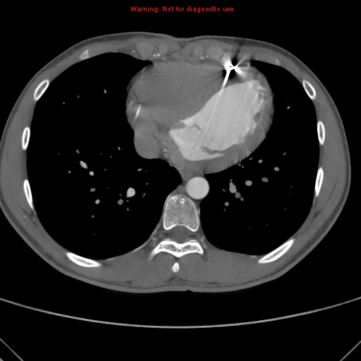 File:Coarctation of the aorta (Radiopaedia 9434-10118 A 136).jpg