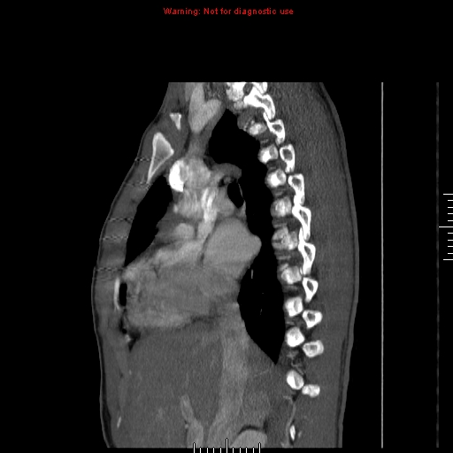 Coarctation of the aorta (Radiopaedia 9434-10118 B 21).jpg