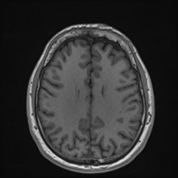 File:Cochlear incomplete partition type III associated with hypothalamic hamartoma (Radiopaedia 88756-105498 Axial T1 131).jpg
