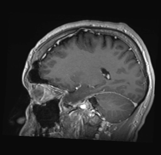 Cochlear incomplete partition type III associated with hypothalamic hamartoma (Radiopaedia 88756-105498 Sagittal T1 C+ 20).jpg