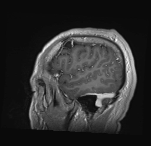 Cochlear incomplete partition type III associated with hypothalamic hamartoma (Radiopaedia 88756-105498 Sagittal T1 C+ 45).jpg