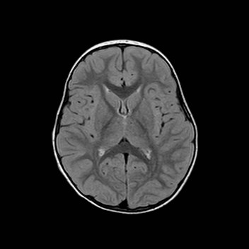 File:Cochlear nerve aplasia - unilateral (Radiopaedia 87910-104413 Axial FLAIR 19).jpg
