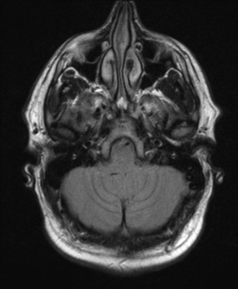 File:Colloid cyst (Radiopaedia 44510-48181 Axial FLAIR 5).png