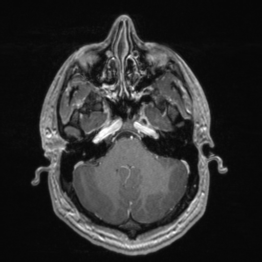 File:Colloid cyst (Radiopaedia 44510-48181 Axial T1 C+ 51).png