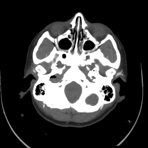 File:Colloid cyst (resulting in death) (Radiopaedia 33423-34499 A 9).png