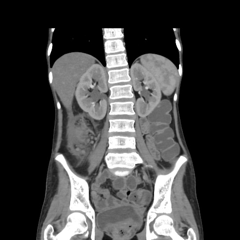 File:Colocolic fistula - Crohn disease (Radiopaedia 57063-63955 B 29).jpg