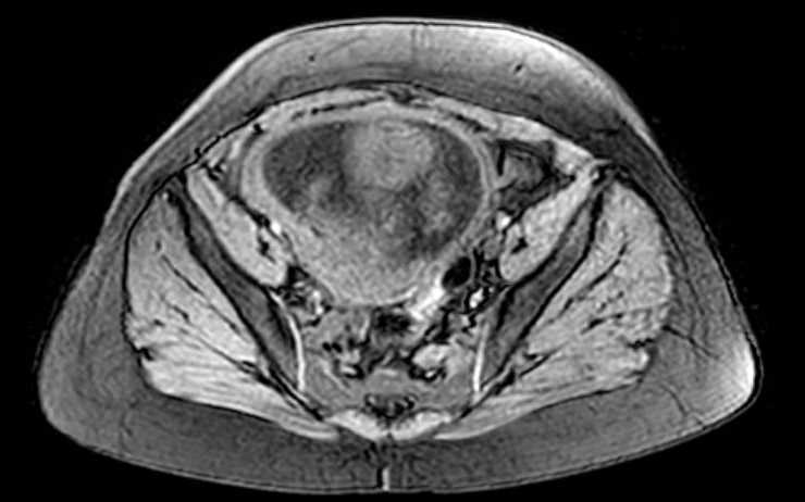 Colon adenocarcinoma with Krukenberg tumors, advanced pregnancy (Radiopaedia 67279-76645 A 21).jpg