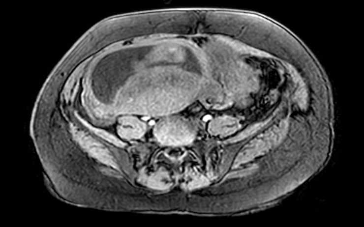 Colon adenocarcinoma with Krukenberg tumors, advanced pregnancy (Radiopaedia 67279-76645 A 30).jpg