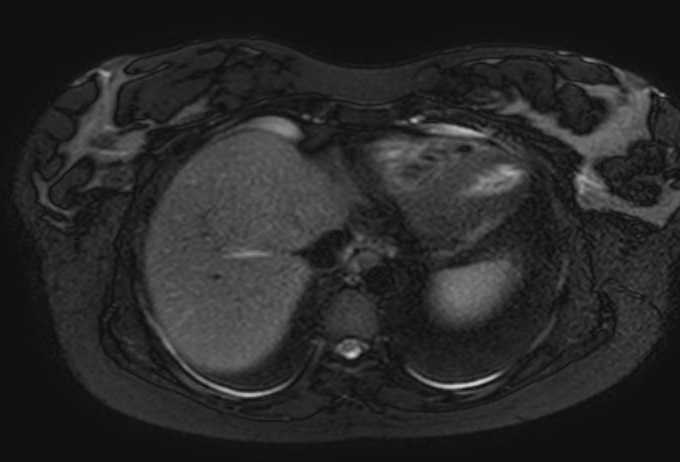 Colon adenocarcinoma with Krukenberg tumors, advanced pregnancy (Radiopaedia 67279-76645 Axial T2 SPAIR 78).jpg