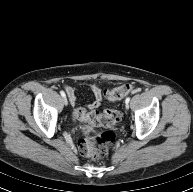 Colon carcinoma with hepatic metastases (Radiopaedia 29477-29961 A 100).jpg