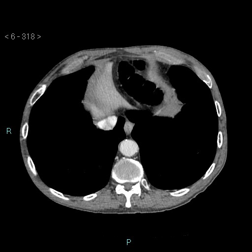 Colonic cancer (ultrasound and TC imaging) (Radiopaedia 50346-55713 B 318).jpg