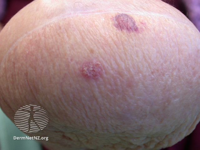 File:Intraepithelial carcinoma on amputation stump (DermNet NZ reactions-amputation-stump-12).jpg