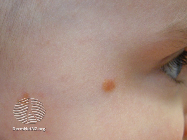 File:Juvenile xanthogranuloma (DermNet NZ lesions-jxg5).jpg