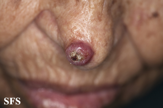 File:Keratoacanthoma (Dermatology Atlas 62).jpg