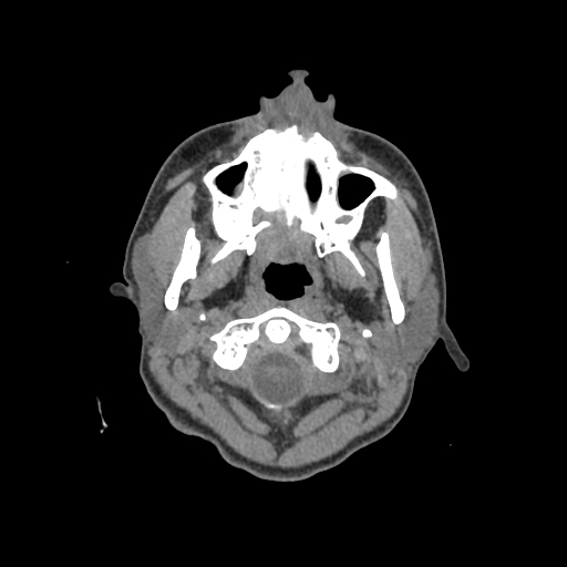 Nasal pyogenic granuloma (lobular capillary hemangioma) (Radiopaedia 85536-101244 Axial non-contrast 5).jpg