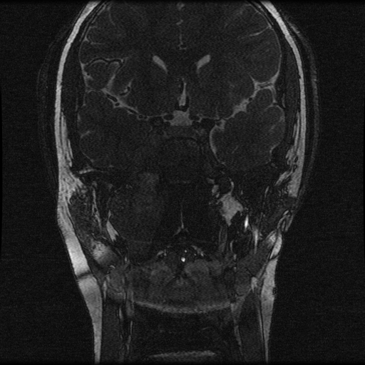 File:Nasopharyngeal rhabdomyosarcoma (Radiopaedia 23417-23486 F 4).jpg