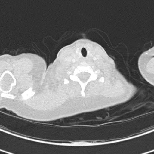 Necrobiotic pulmonary nodules - Crohn disease (Radiopaedia 20723-20631 Axial lung window 1).jpg