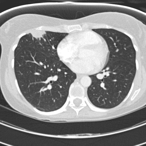 Necrobiotic pulmonary nodules - Crohn disease (Radiopaedia 20723-20631 Axial lung window 87).jpg