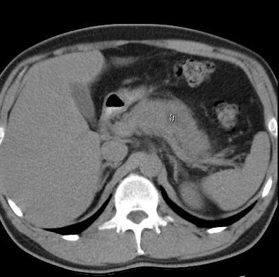 File:Necrotizing pancreatitis with acute necrotic collection (Radiopaedia 14470-14417 Axial non-contrast 9).jpg