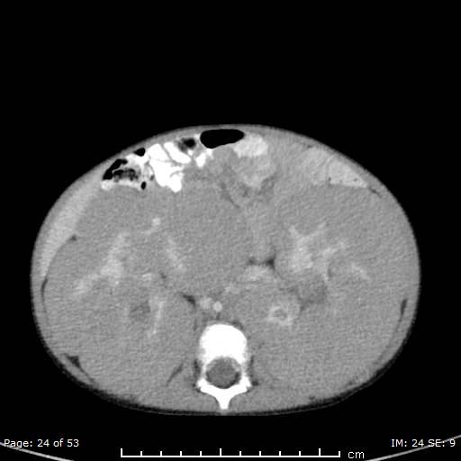 File:Nephroblastomatosis (Radiopaedia 41934-44935 A 24).jpg
