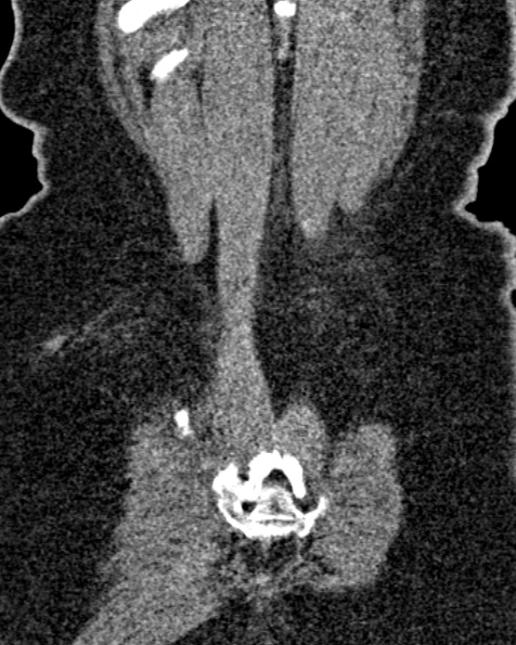 File:Nephrostomy for urosepsis (Radiopaedia 26180-26330 non-contrast 81).jpg