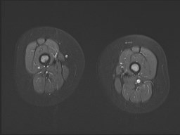 File:Neuroblastoma with bone metastases (Radiopaedia 67080-76414 Axial STIR 24).jpg