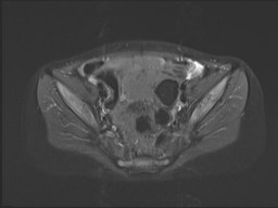 File:Neuroblastoma with bone metastases (Radiopaedia 67080-76414 Axial STIR 54).jpg
