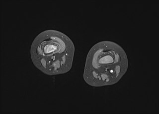 File:Neuroblastoma with bone metastases (Radiopaedia 67080-76414 Axial T1 C+ fat sat 13).jpg