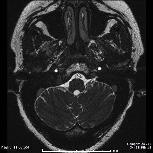 Neurocysticercosis (Radiopaedia 58636-65832 I 38).jpg
