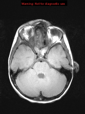 File:Neurofibromatosis type 1 with optic nerve glioma (Radiopaedia 16288-15965 Axial T1 17).jpg