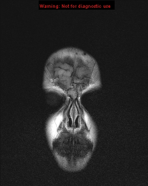 File:Neurofibromatosis type 1 with optic nerve glioma (Radiopaedia 16288-15965 Coronal FLAIR 25).jpg