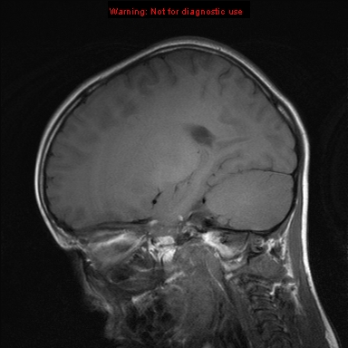 File:Neurofibromatosis type 1 with optic nerve glioma (Radiopaedia 16288-15965 Sagittal T1 9).jpg