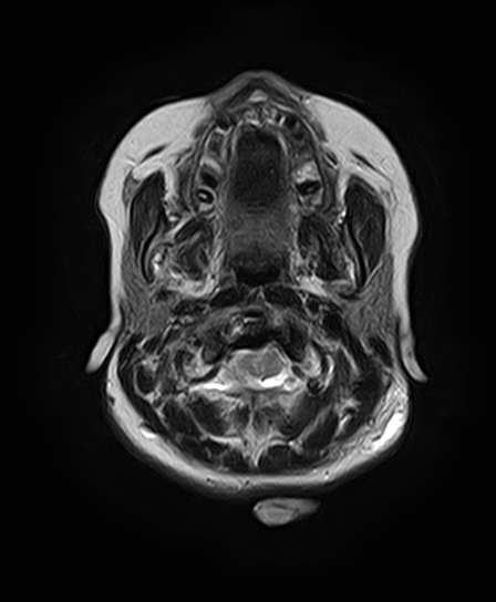 File:Neurofibromatosis type 2 (Radiopaedia 66211-75401 Axial T2 6).jpg