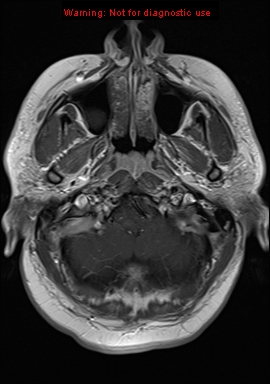 File:Neuroglial cyst (Radiopaedia 10713-11184 Axial T1 C+ 21).jpg
