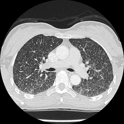 File:Non-small cell lung cancer with miliary metastases (Radiopaedia 23995-24193 Axial lung window 11).jpg