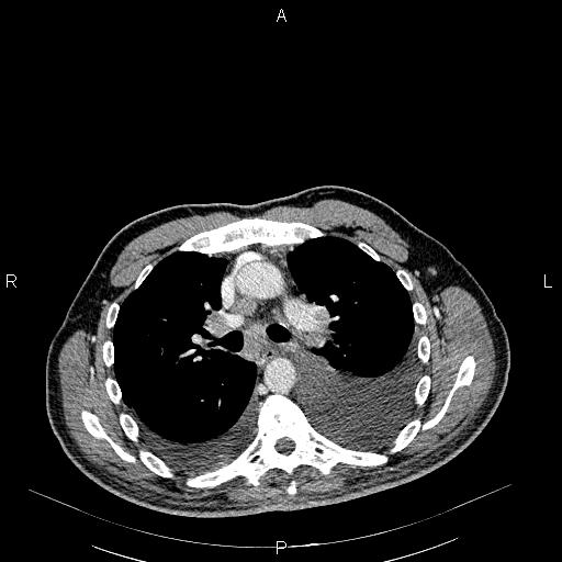 File:Non Hodgkin lymphoma in a patient with ankylosing spondylitis (Radiopaedia 84323-99621 B 14).jpg