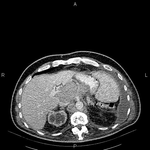 File:Non Hodgkin lymphoma in a patient with ankylosing spondylitis (Radiopaedia 84323-99621 B 31).jpg