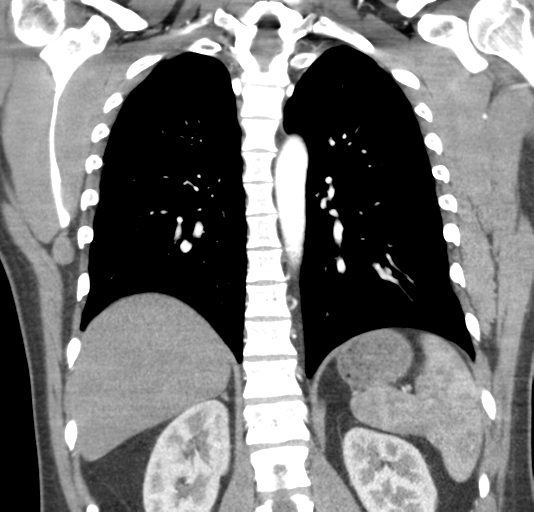 File:Normal CTA thorax (non ECG gated) (Radiopaedia 41750-44704 B 60).png