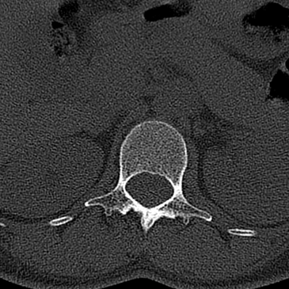 File:Normal CT lumbar spine (Radiopaedia 53981-60118 Axial bone window 13).jpg