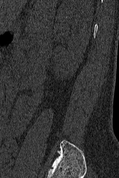 File:Normal CT lumbar spine (Radiopaedia 53981-60118 Sagittal bone window 92).jpg