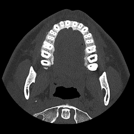 Normal CT paranasal sinuses (Radiopaedia 42286-45390 Axial bone window 107).jpg